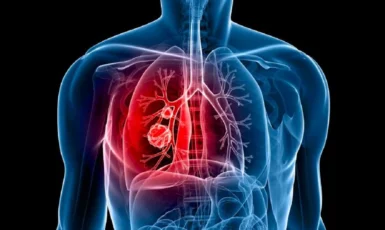 Triệu chứng ung thư phổi giai đoạn đầu