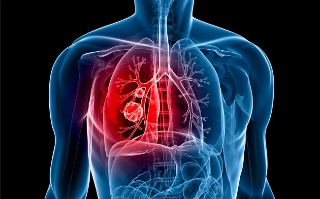 Khối u di căn sang phổi