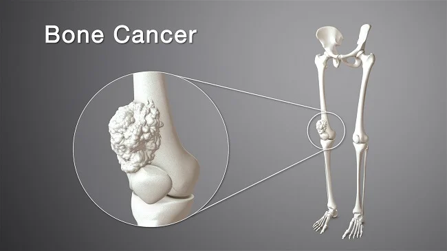 Ung thư xương