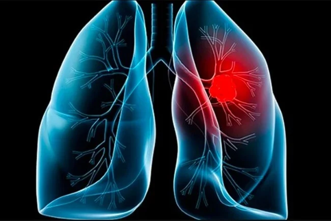 Ung thư di căn phổi