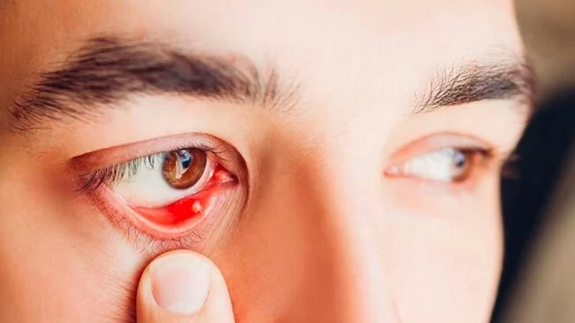 Tác dụng phụ ít gặp ở mắt như viêm kết mạc, giảm thị lực,...