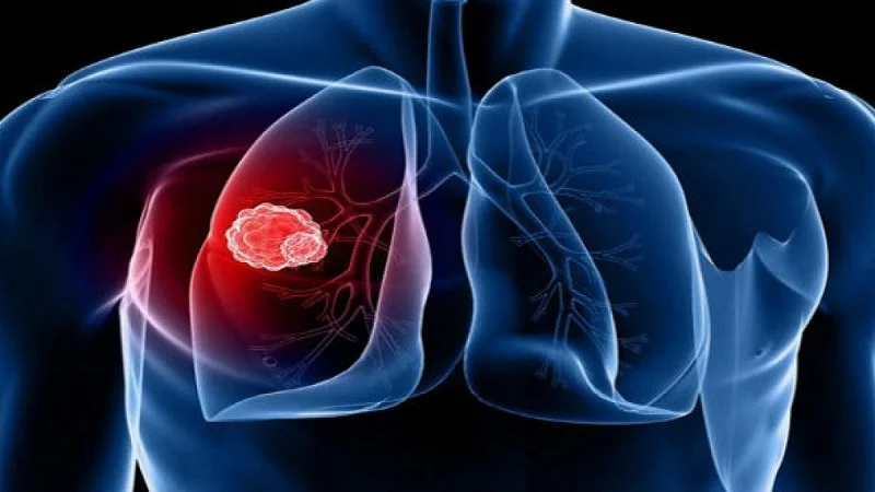 Ung thư tại phổi