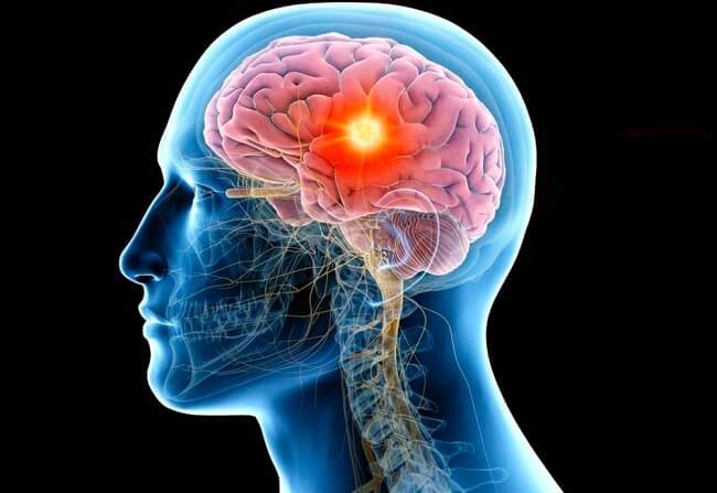 Xạ trị VMAT dùng cho di căn não an toàn