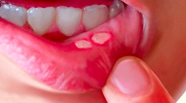 Hóa trị gây ra các tác dụng phụ trên răng miệng