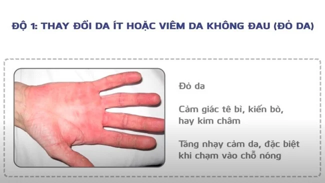 Độ 1 của hội chứng bàn tay bàn chân