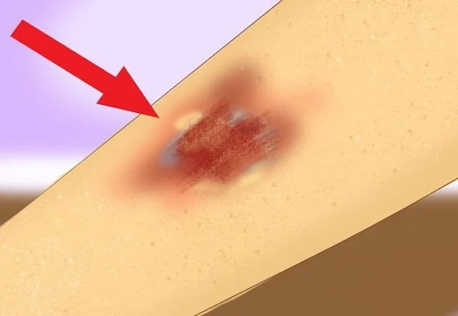 Nhiễm trùng tại vết loét hoặc phát ban trên da