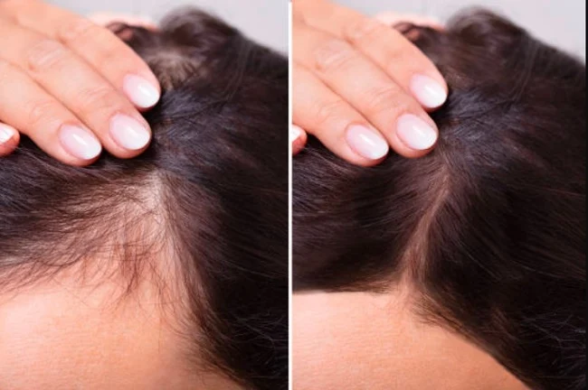 Sau 1 năm điều trị tóc có thể mọc dài 10 - 15cm