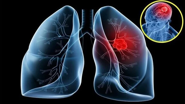 Ung thư phổi giai đoạn 4B đã lan tới một hoặc nhiều cơ quan xa như não, gan,...