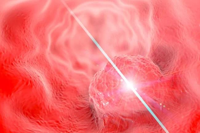 Liệu pháp laser điều trị ung thư