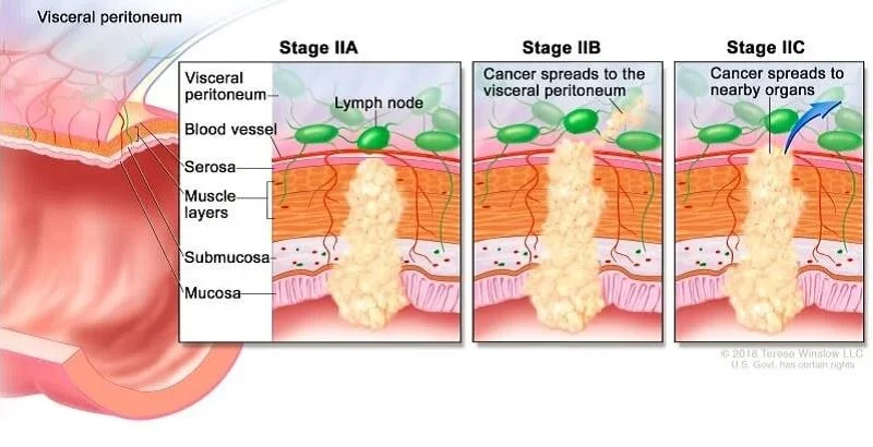 Các giai đoạn của ung thư vòm họng