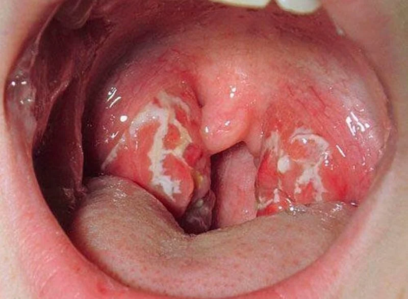 Ung thư vòm họng giai đoạn cuối