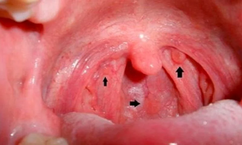 Ung thư vòm họng giai đoạn đầu