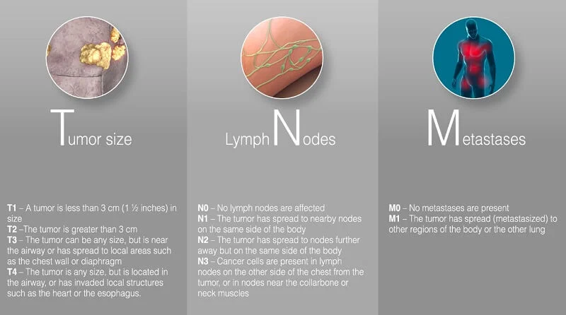 Hệ thống TNM phân loại giai đoạn ung thư