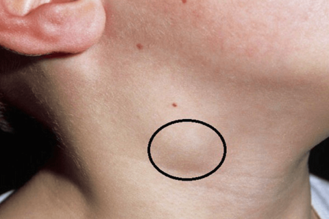 Nổi hạch vùng cổ trong ung thư vòm họng giai đoạn 3