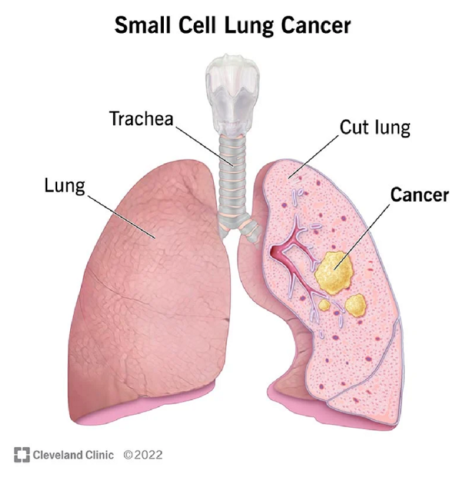 Ung thư phổi tế bào nhỏ chỉ chiếm 15% các ca ung thư phế quản phổi nhưng lại đặc biệt nguy hiểm