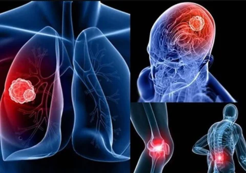 Ung thư gan thường di căn tới phổi, não, xương, hạch