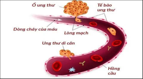 Tế bào ung thư thường đi vào máu để lây lan tới các cơ quan trong cơ thể
