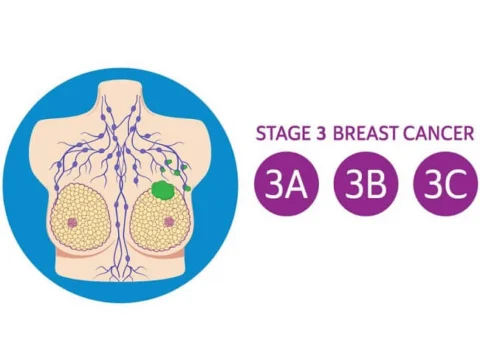 Ung thư vú giai đoạn 3 được chia làm 3 giai đoạn nhỏ là 3A, 3B, 3C