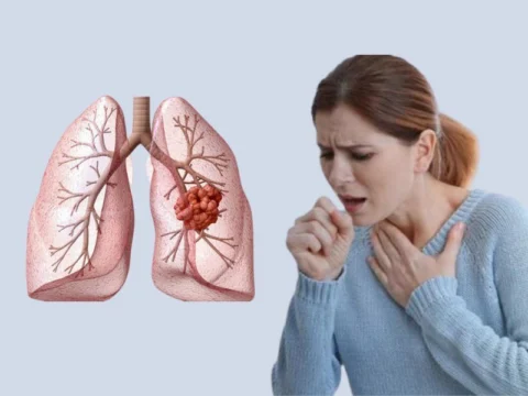 Bệnh nhân ung thư phổi giai đoạn 3 có biểu hiện ho nhiều dai dẳng