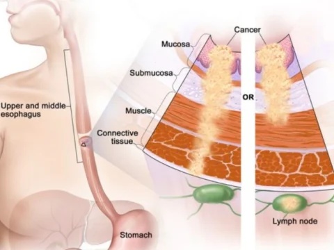 Ung thư thực quản giai đoạn 2 là giai đoạn các tế bào ung thư đã tăng lên và lấn sâu vào các lớp thực quản
