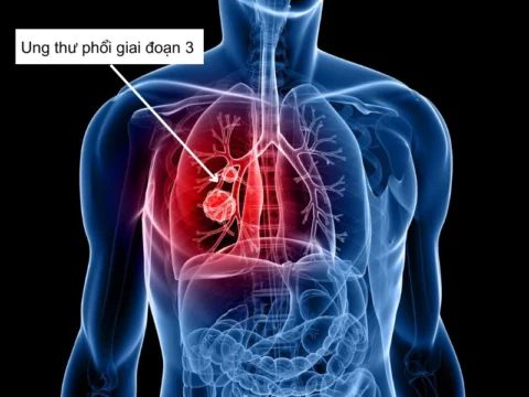 Bước vào giai đoạn 3 của bệnh ung thư phổi, các tế bào ác tính nhân lên một cách nhanh chóng và lan rộng tới nhiều thùy phổi