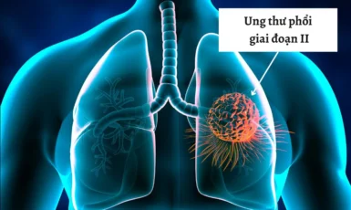 Tiên lượng và cách điều trị ung thư phổi giai đoạn 2