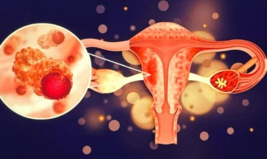 Ung thư buồng trứng giai đoạn đầu
