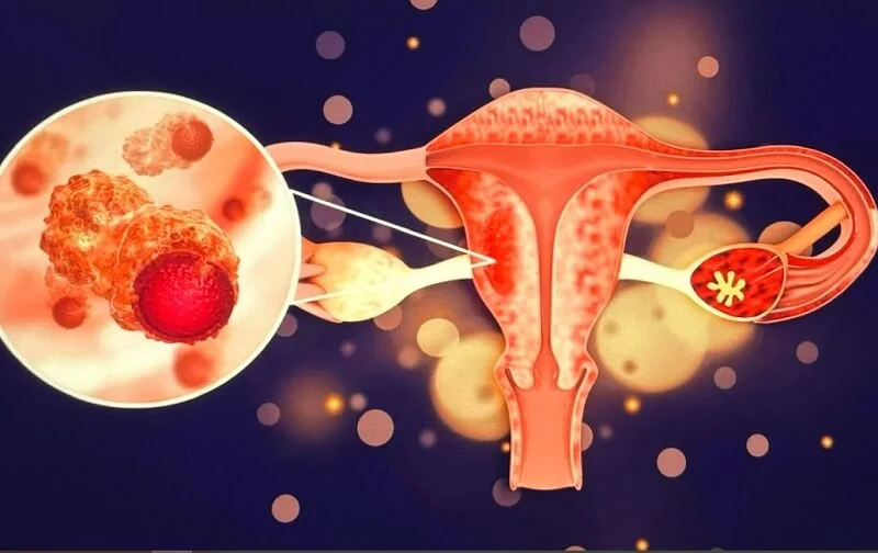 Ung thư buồng trứng giai đoạn đầu